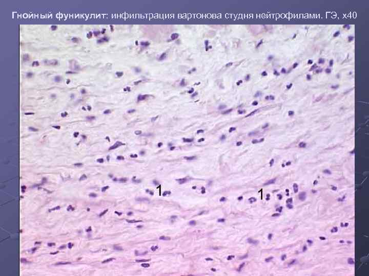 Гнойный фуникулит: инфильтрация вартонова студня нейтрофилами. ГЭ, х40 