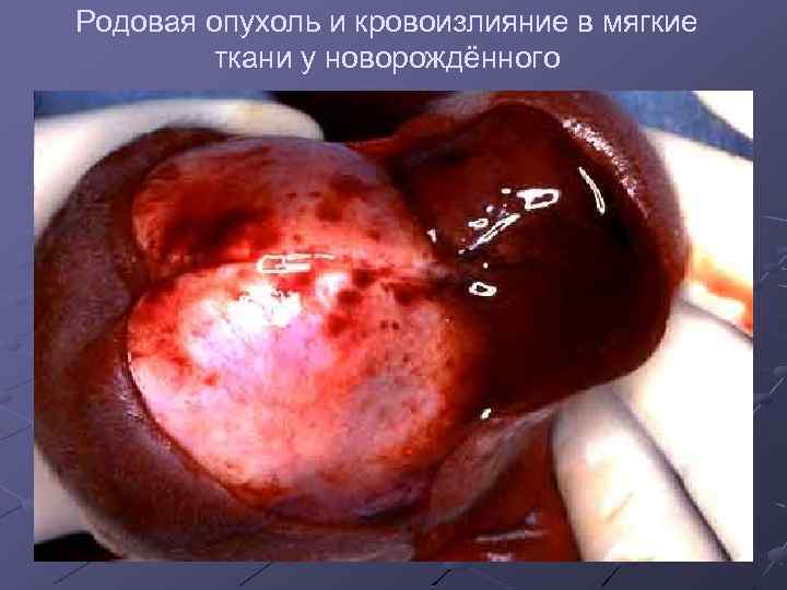 Родовая опухоль и кровоизлияние в мягкие ткани у новорождённого 