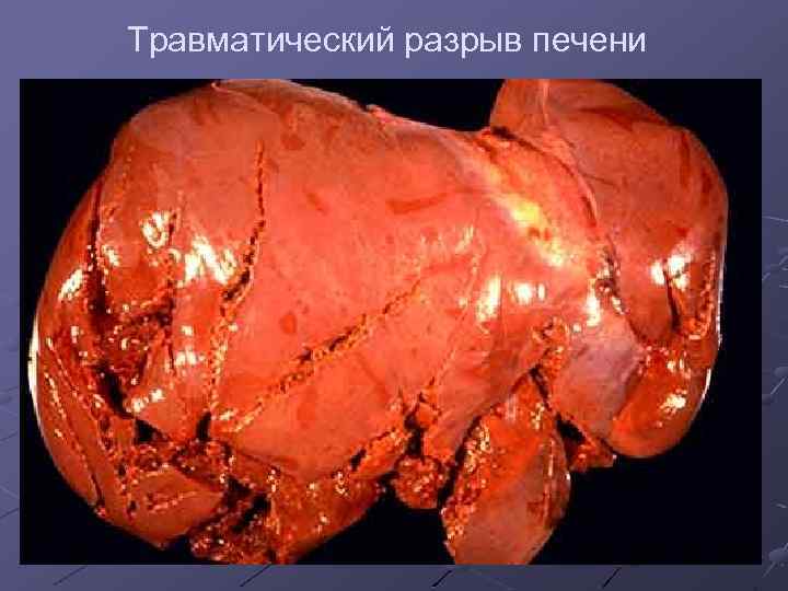 Травматический разрыв печени 
