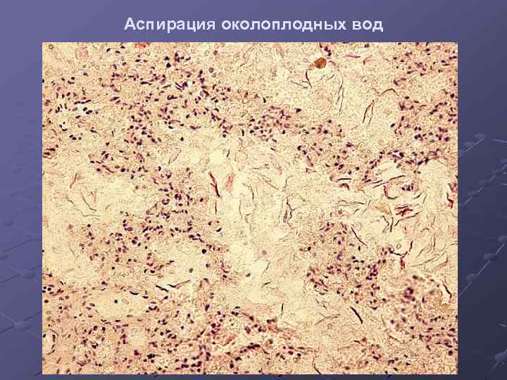 Аспирация околоплодных вод 