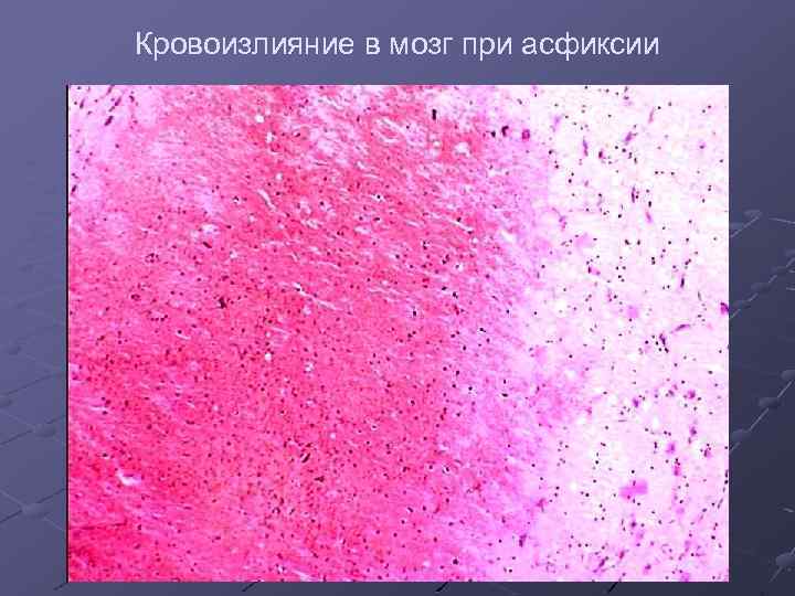 Кровоизлияние в мозг при асфиксии 