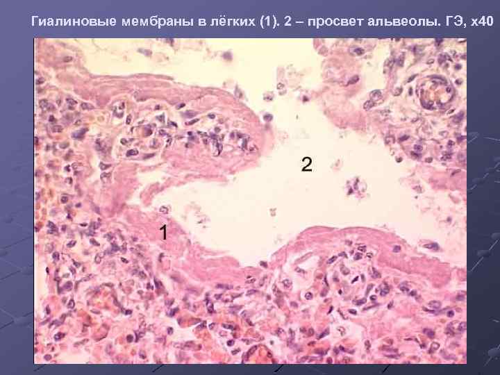 Гиалиновые мембраны в лёгких (1). 2 – просвет альвеолы. ГЭ, х40 