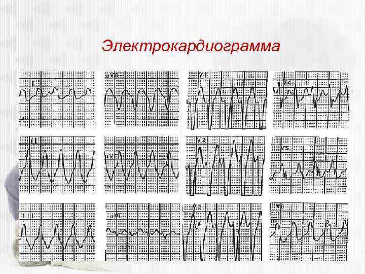 Электрокардиограмма 