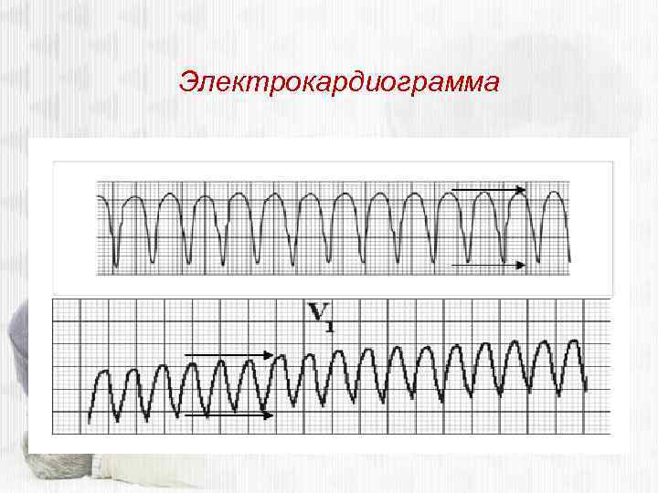 Электрокардиограмма 