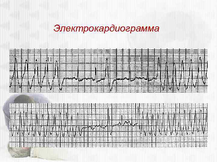 Электрокардиограмма 