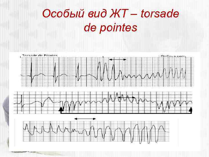 Особый вид ЖТ – torsade de pointes 