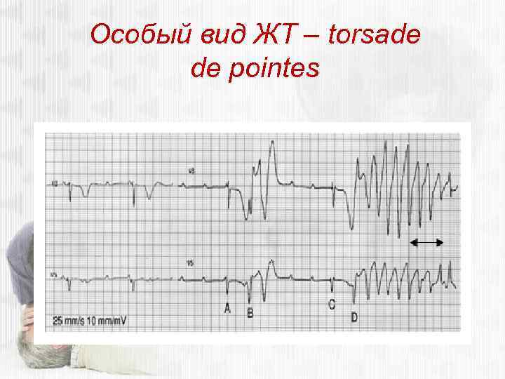 Особый вид ЖТ – torsade de pointes 