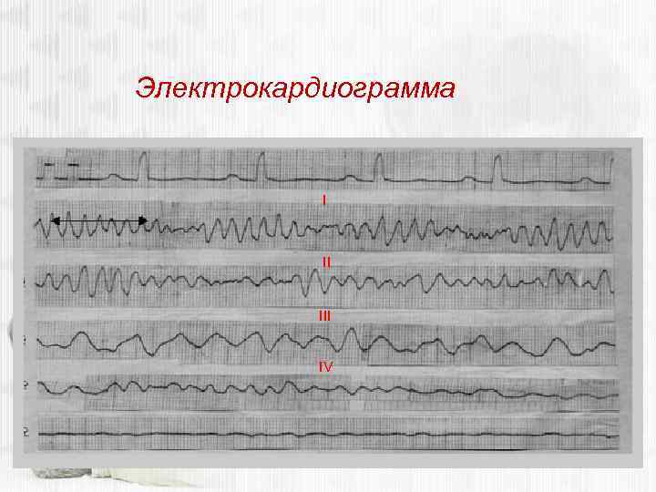 Электрокардиограмма I II IV 