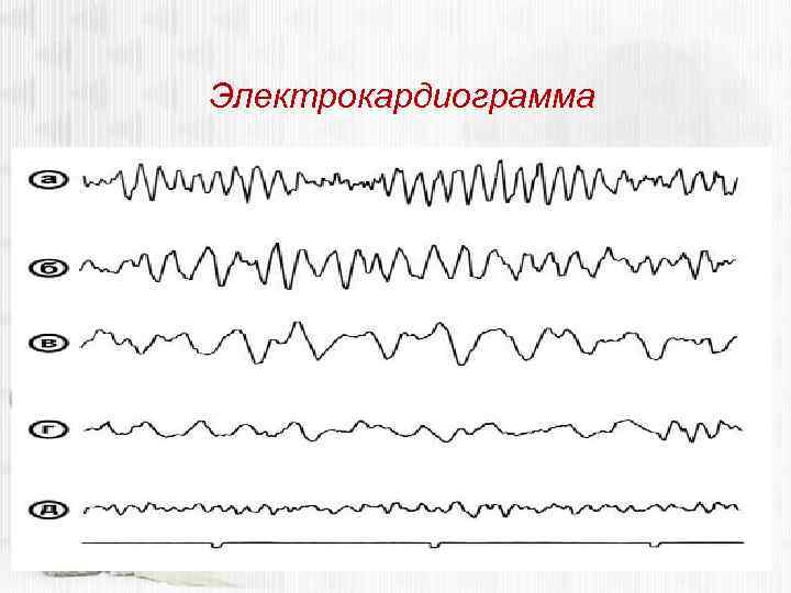 Электрокардиограмма 