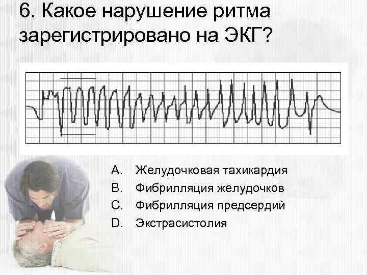 6. Какое нарушение ритма зарегистрировано на ЭКГ? A. B. C. D. Желудочковая тахикардия Фибрилляция