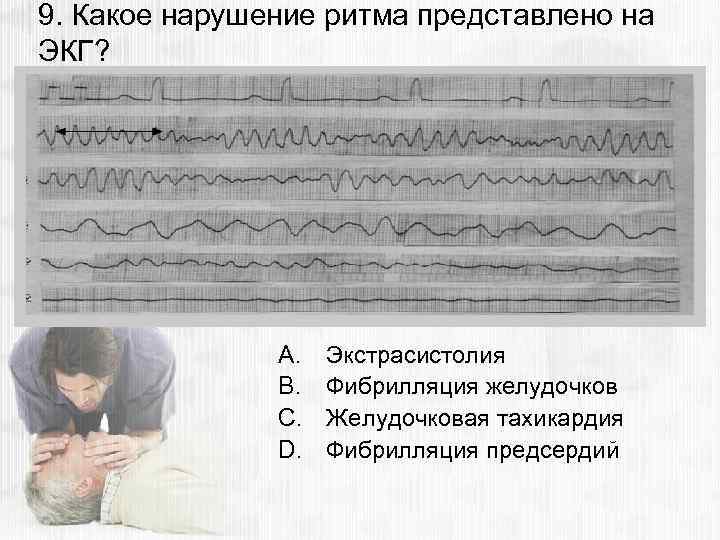 9. Какое нарушение ритма представлено на ЭКГ? A. B. C. D. Экстрасистолия Фибрилляция желудочков