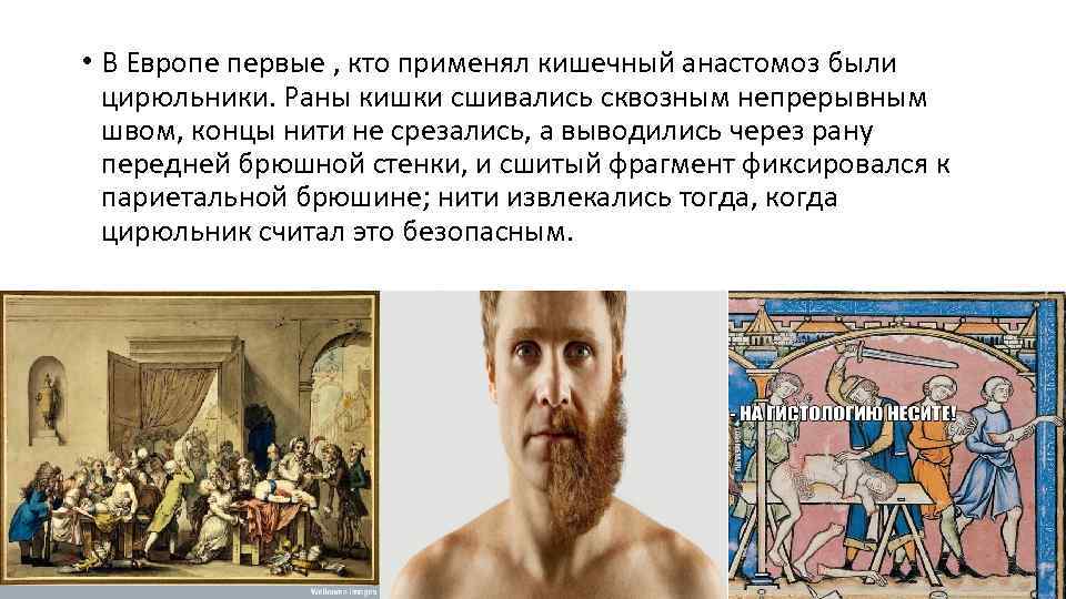  • В Европе первые , кто применял кишечный анастомоз были цирюльники. Раны кишки