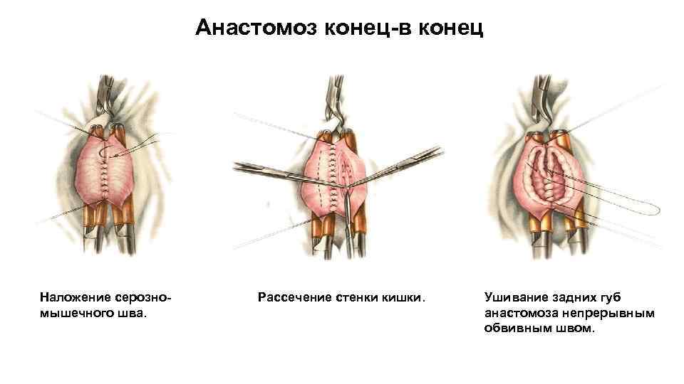 Анастомоз конец в конец схема