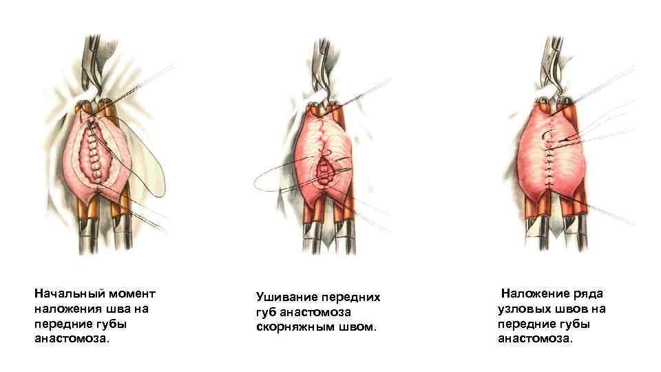 Начальный момент наложения шва на передние губы анастомоза. Ушивание передних губ анастомоза скорняжным швом.