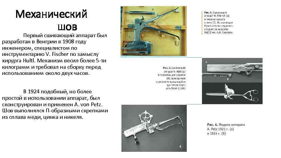 Механический шов Первый сшивающий аппарат был разработан в Венгрии в 1908 году инженером, специалистом