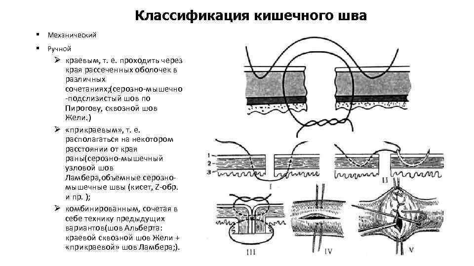 Классификация кишечного шва § Механический § Ручной Ø краевым, т. е. проходить через края