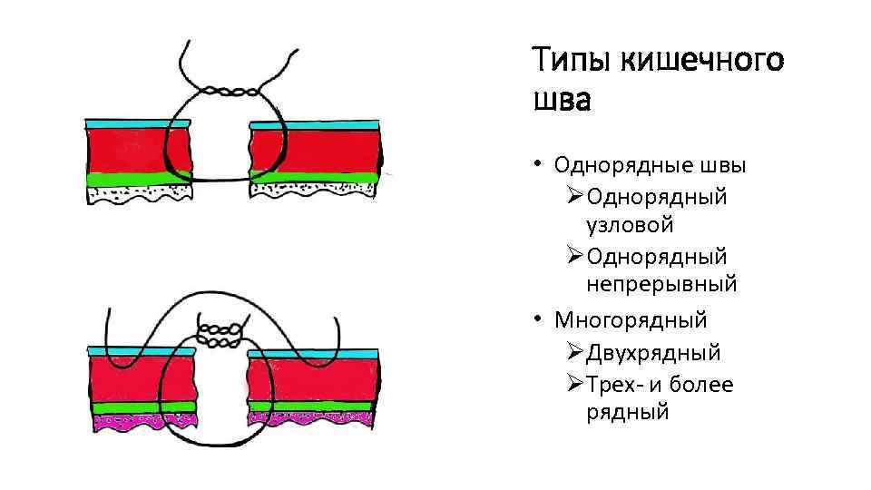 Типы кишечного шва • Однорядные швы ØОднорядный узловой ØОднорядный непрерывный • Многорядный ØДвухрядный ØТрех-