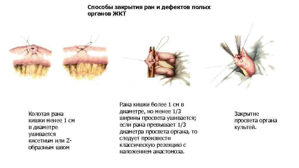 Способы закрытия ран и дефектов полых органов ЖКТ Колотая рана кишки менее 1 см