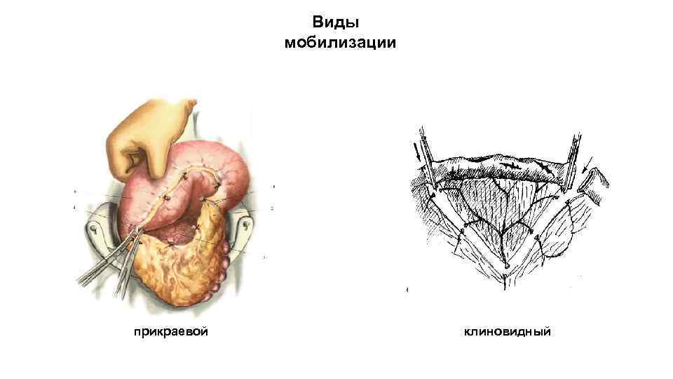  Виды мобилизации прикраевой клиновидный 