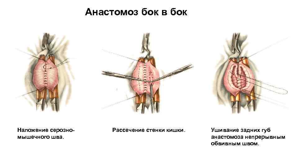 Анастомоз бок в бок Наложение серозномышечного шва. Рассечение стенки кишки. Ушивание задних губ анастомоза