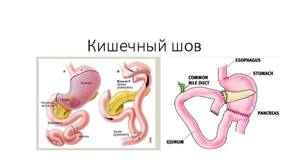 Кишечный шов 