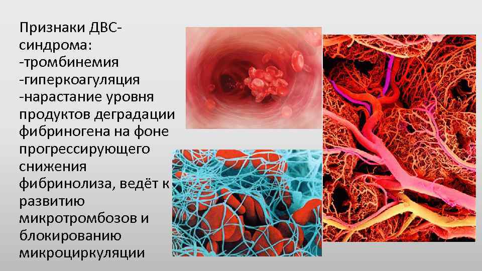 Признаки ДВСсиндрома: -тромбинемия -гиперкоагуляция -нарастание уровня продуктов деградации фибриногена на фоне прогрессирующего снижения фибринолиза,