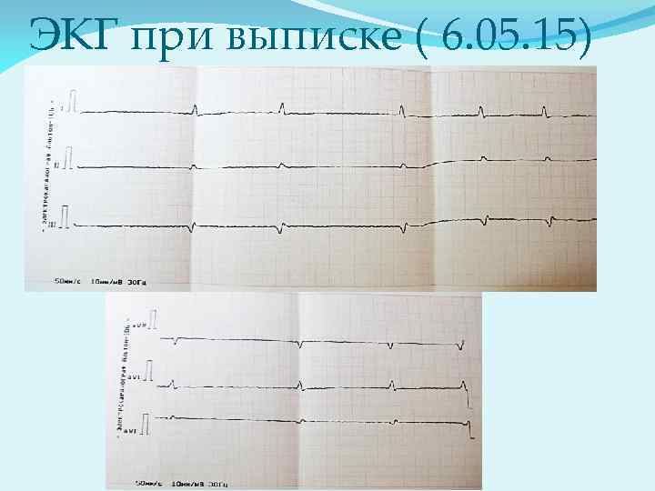 ЭКГ при выписке ( 6. 05. 15) 