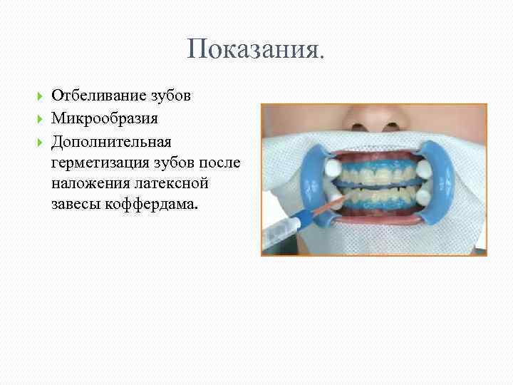 Показания. Отбеливание зубов Микрообразия Дополнительная герметизация зубов после наложения латексной завесы коффердама. 