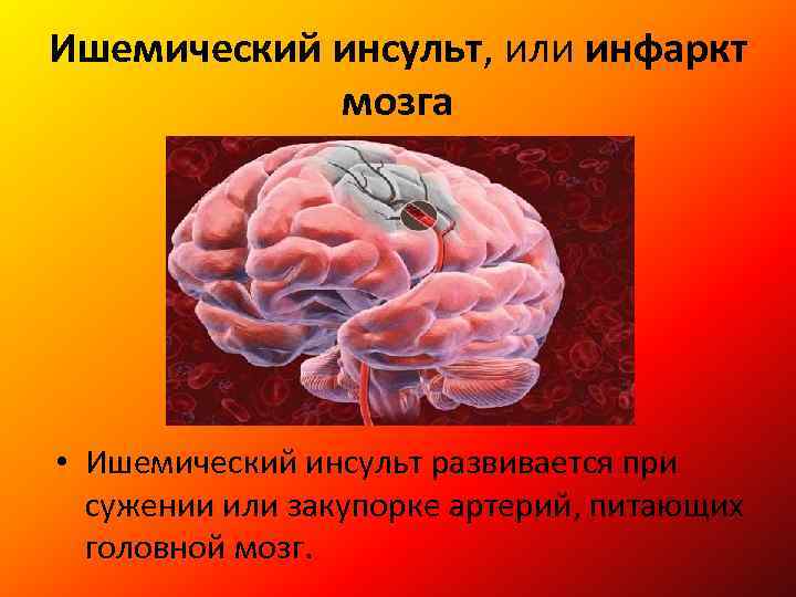 Инсульт различия. Инфаркт головного мозга и инсульт. Ишемический инсульт (инфаркт мозга). Инфаркт головного мозга симптомы.