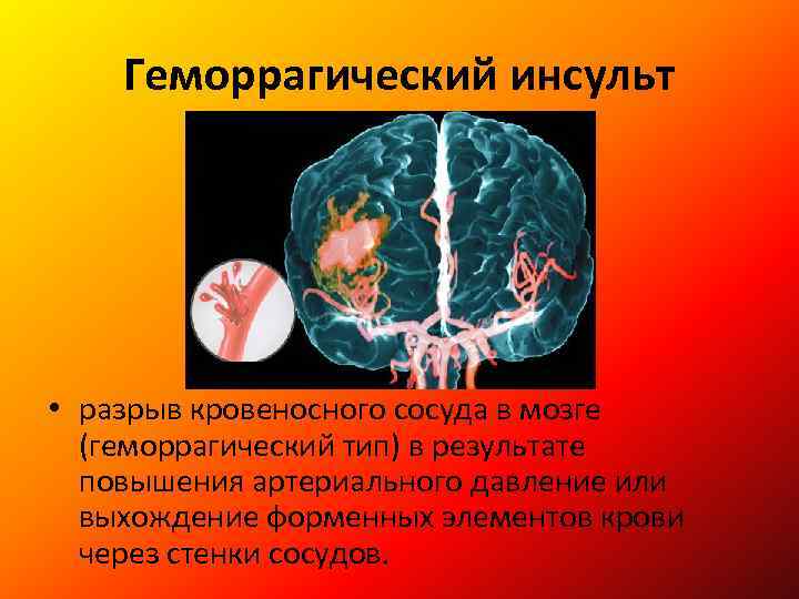 Инсульт геморрагический правая