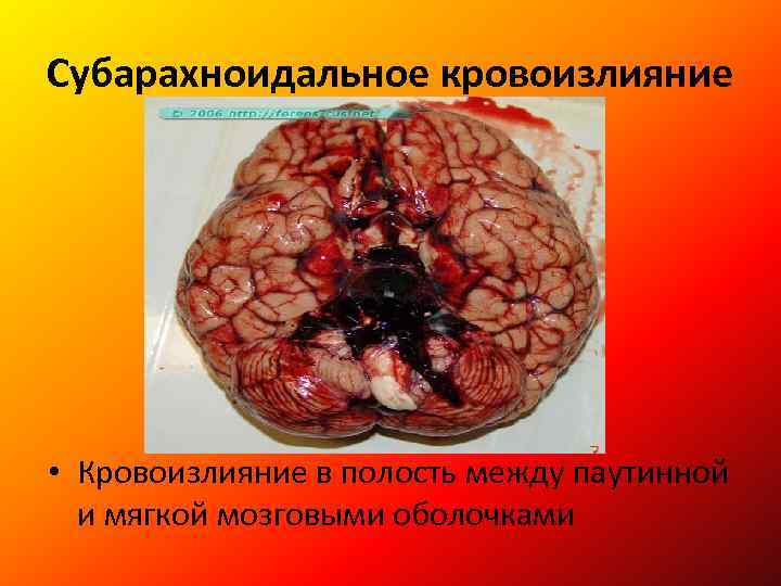 Субарахноидальное кровоизлияние • Кровоизлияние в полость между паутинной и мягкой мозговыми оболочками 