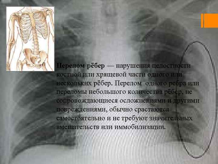 Перелом рёбер — нарушения целостности костной или хрящевой части одного или нескольких рёбер. Перелом