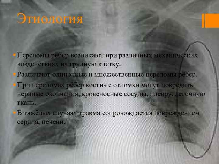 Этиология § Переломы рёбер возникают при различных механических воздействиях на грудную клетку. § Различают