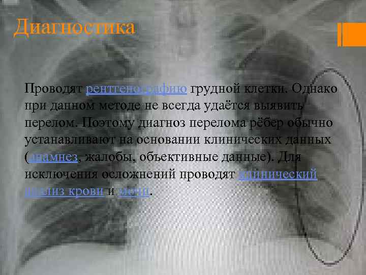 Диагностика Проводят рентгенографию грудной клетки. Однако при данном методе не всегда удаётся выявить перелом.