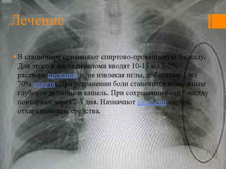 Лечение § В стационаре применяют спиртово-прокаиновую блокаду. Для этого в месте перелома вводят 10