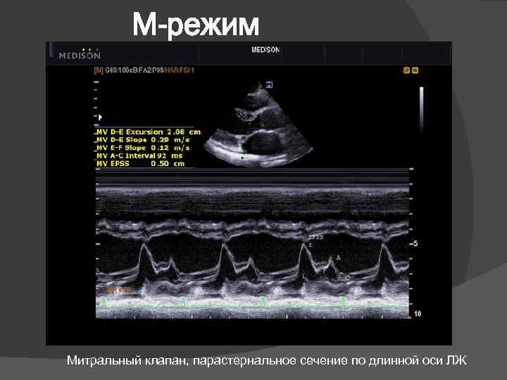 М-режим Митральный клапан, парастернальное сечение по длинной оси ЛЖ 