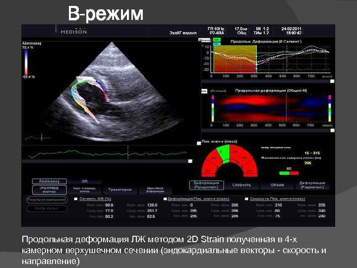 В-режим Продольная деформация ЛЖ методом 2 D Strain полученная в 4 -х камерном верхушечном