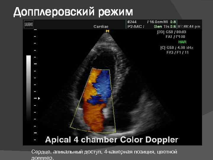 Эхокардиография с допплеровским анализом