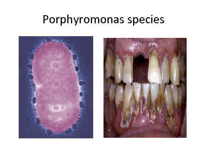 Porphyromonas species 