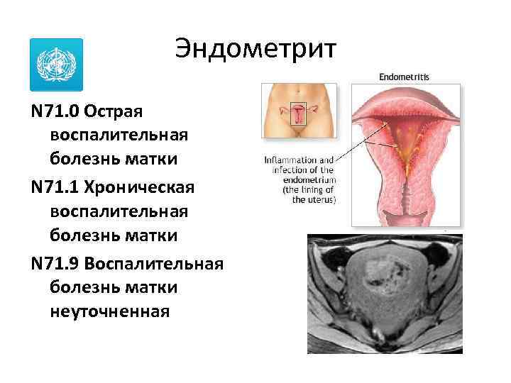 Воспаление матки у женщин симптомы и лечение. Воспалительные заболевания эндометрит. Острый эндометрит гинекология. Эндометрит болезнь симптомы.