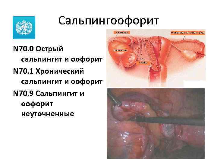 Сальпингоофорит N 70. 0 Острый сальпингит и оофорит N 70. 1 Хронический сальпингит и