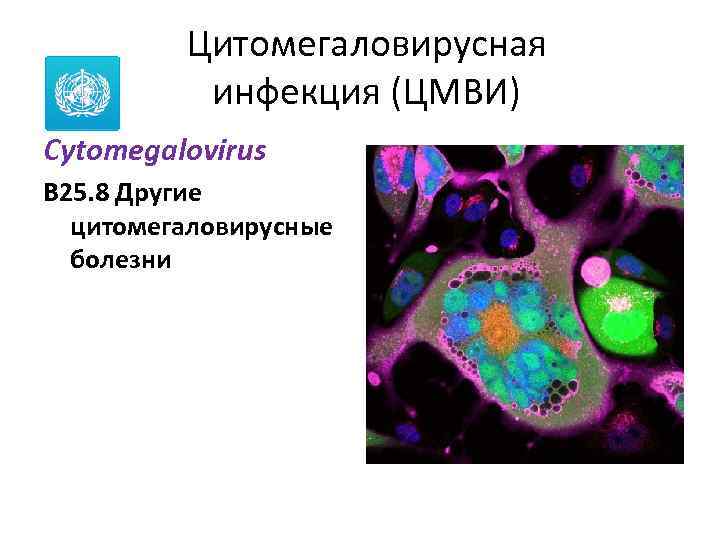 Цитомегаловирусная инфекция (ЦМВИ) Cytomegalovirus B 25. 8 Другие цитомегаловирусные болезни 