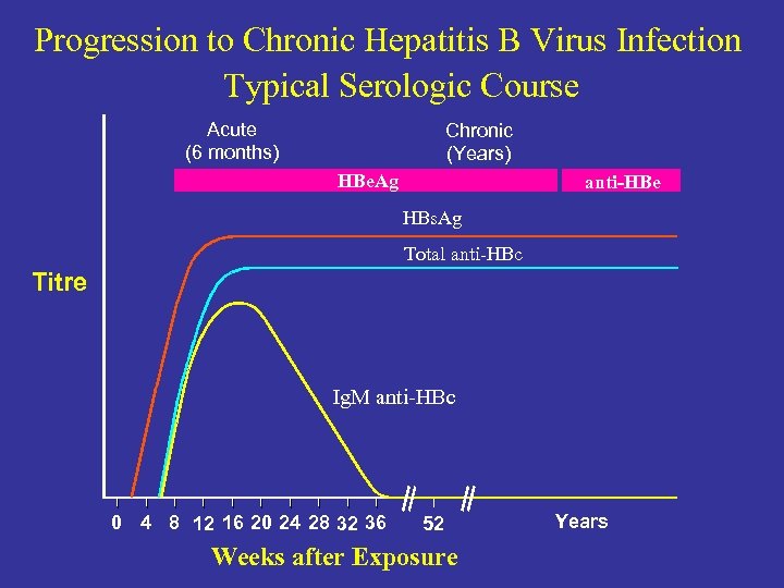Progression to Chronic Hepatitis B Virus Infection Typical Serologic Course Acute (6 months) Chronic
