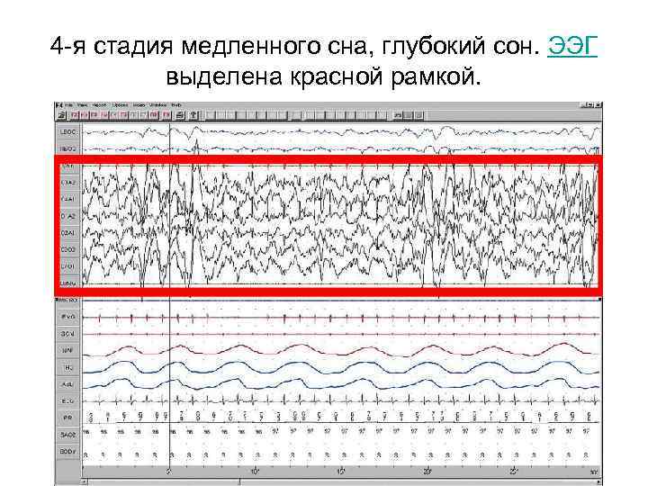 4 -я стадия медленного сна, глубокий сон. ЭЭГ выделена красной рамкой. 