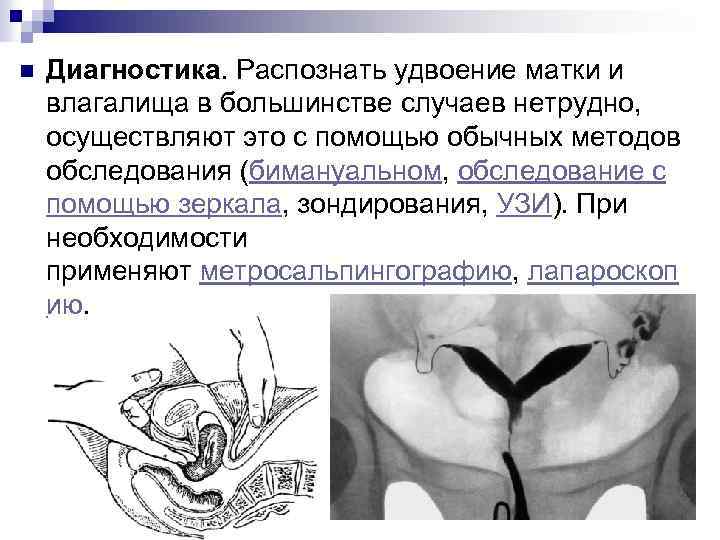 n Диагностика. Распознать удвоение матки и влагалища в большинстве случаев нетрудно, осуществляют это с