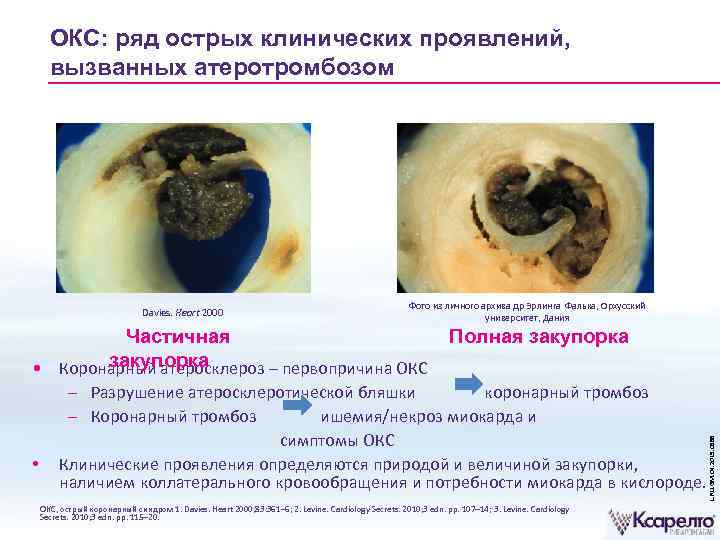 ОКС: ряд острых клинических проявлений, вызванных атеротромбозом Фото из личного архива др Эрлинга Фалька,