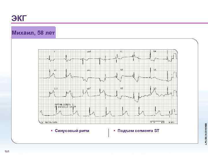 ЭКГ • Синусовый ритм 101 • Подъем сегмента ST L. RU. GM. 04. 2015.