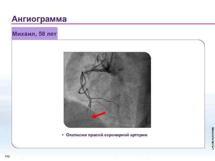 Ангиограмма • Окклюзия правой коронарной артерии 102 L. RU. GM. 04. 2015. 0588 Михаил,