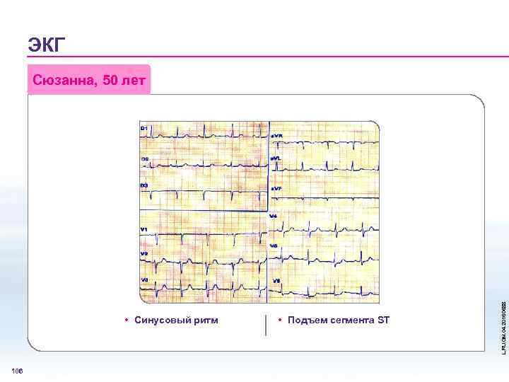 ЭКГ • Синусовый ритм 106 • Подъем сегмента ST L. RU. GM. 04. 2015.