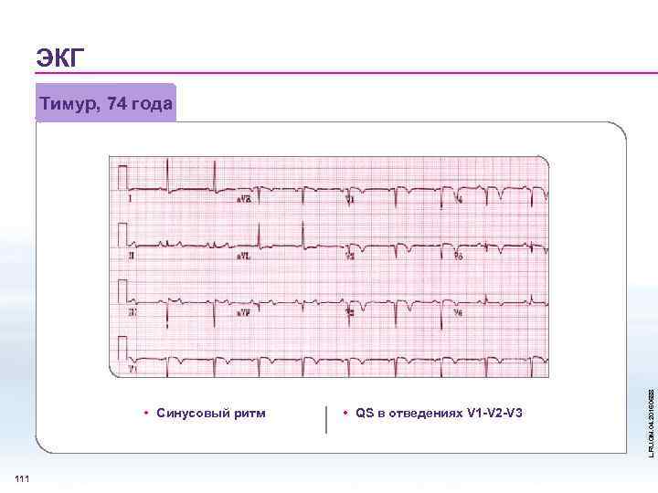 ЭКГ • Синусовый ритм 111 • QS в отведениях V 1 -V 2 -V